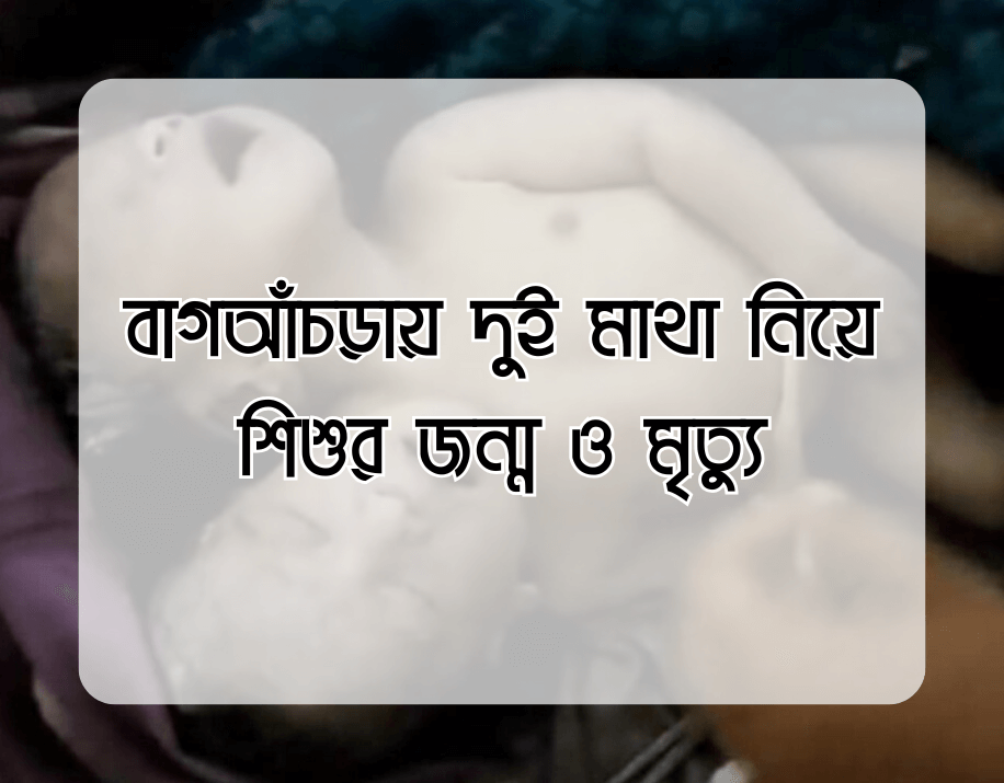 বাগআঁচড়ায় দুই মাথা নিয়ে শিশুর জন্ম ও মৃত্যু